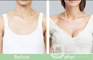 妙桃假體豐胸,假體豐胸價格,妙桃假體豐胸價格