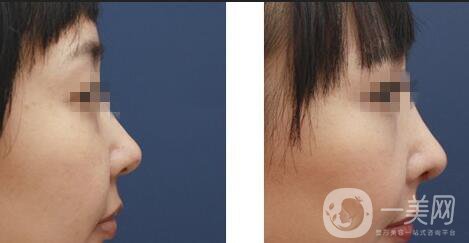 自體軟骨隆鼻術價位