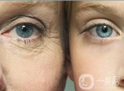 除皺方式 除皺價格