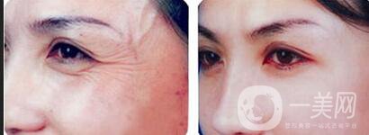 除皺方式 除皺價格