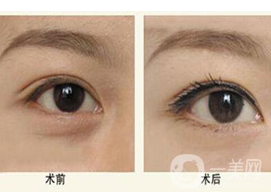 超聲法去眼袋,超聲法去眼袋價格