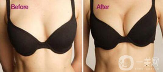 自體豐胸手術(shù)費用