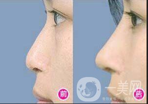 自體隆鼻多少錢(qián)