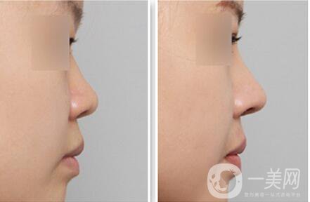 玻尿酸隆鼻價(jià)格