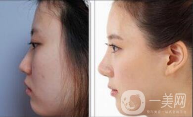 玻尿酸隆鼻價格