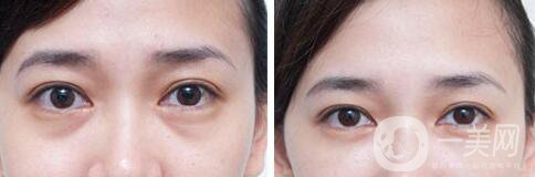 自體脂肪填充淚溝修復(fù)價格