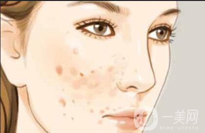 c6激光祛斑貴嗎 術(shù)后如何護理