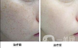 c6激光祛斑貴嗎 術(shù)后如何護理