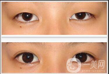 杭州割雙眼皮多少錢,雙眼皮加開眼角費用