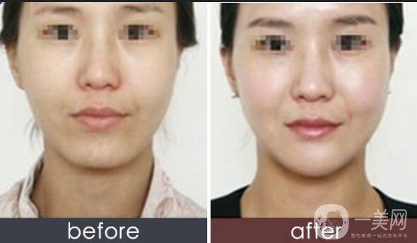 玻尿酸墊下巴價位