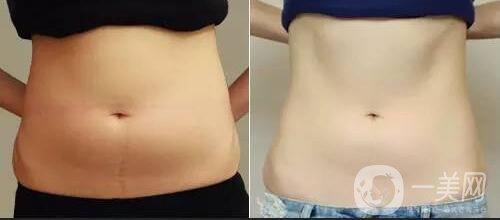 腹部溶脂恢復(fù)過程