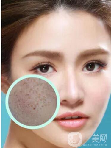 長(zhǎng)了黃褐斑怎么辦 光子嫩膚調(diào)節(jié)黃褐斑價(jià)格