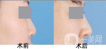 耳軟骨隆鼻手術(shù)多少錢