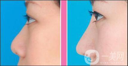 耳軟骨隆鼻手術(shù)多少錢