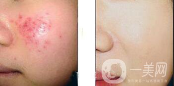 廣東果酸嫩膚價(jià)格