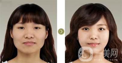 下頜角手術后遺癥都有哪些呢？