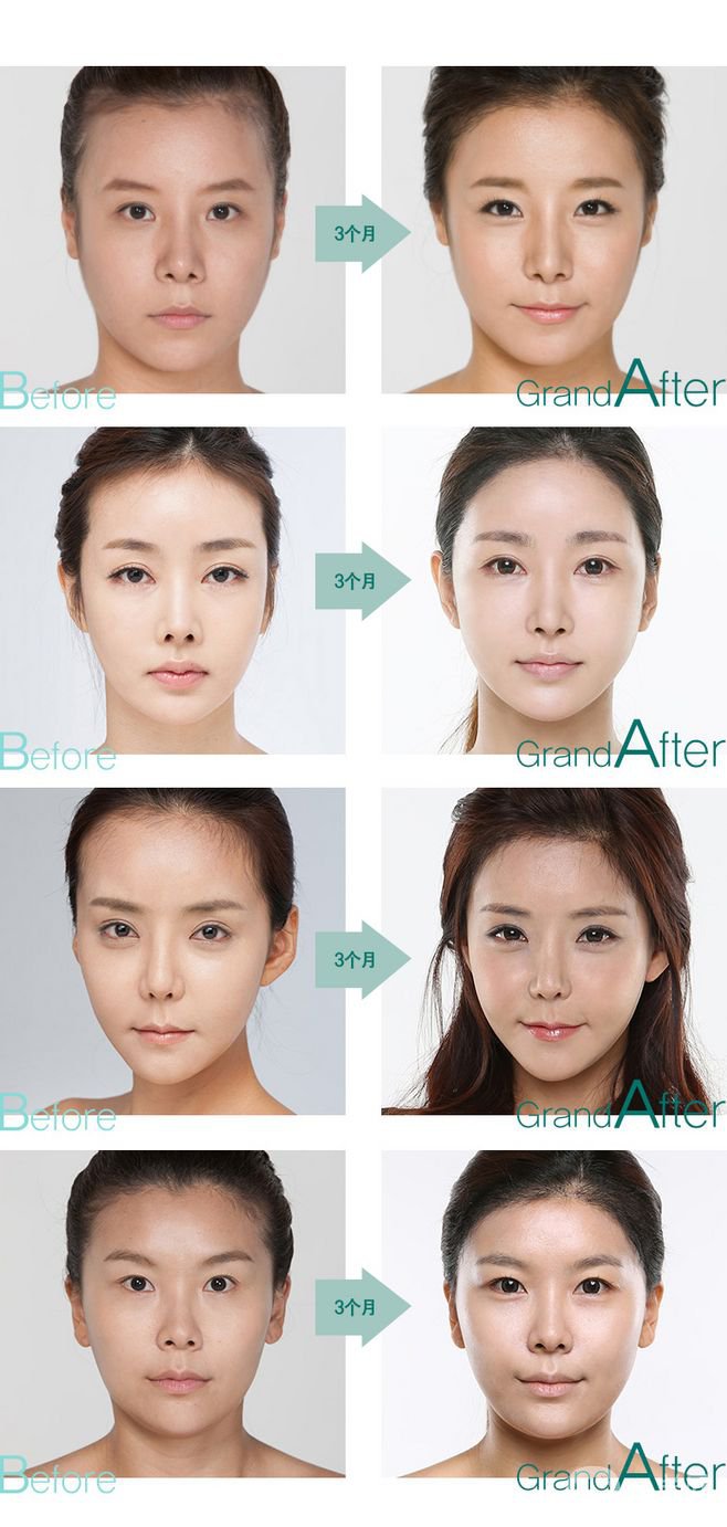 改發(fā)際線價格是多少？