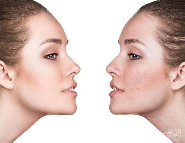 光子嫩膚是什么 價格多少？