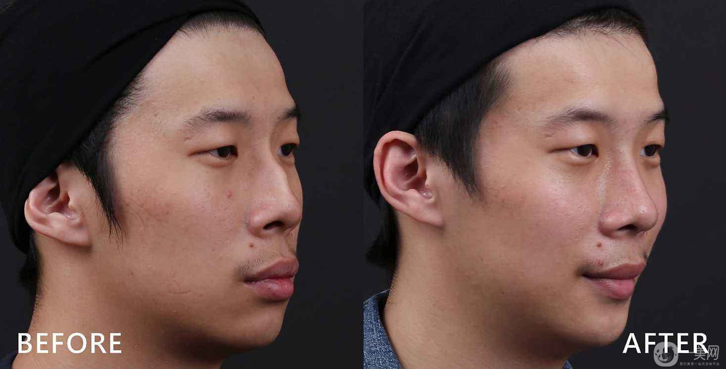 駝峰鼻矯正價格貴嗎 駝峰鼻如何矯正