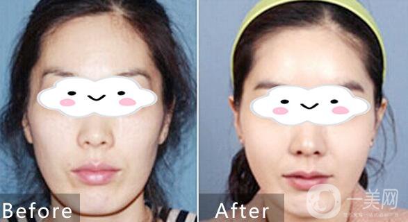 自體脂肪填充,自體脂肪填充優(yōu)勢