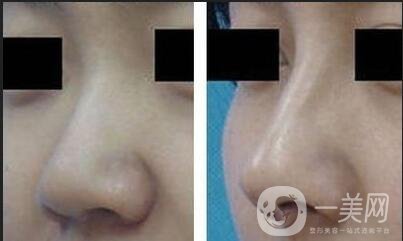 耳軟骨隆鼻*嗎,耳軟骨隆鼻多少錢