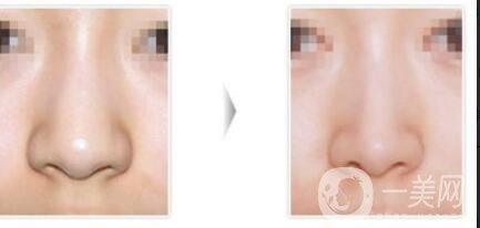 鼻翼縮小整形價格,鼻翼縮小術(shù)后護理
