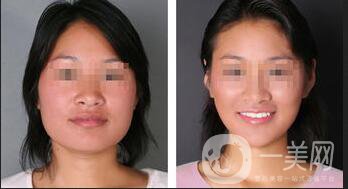 下頜角截骨,下頜角截骨術(shù)后護(hù)理方式