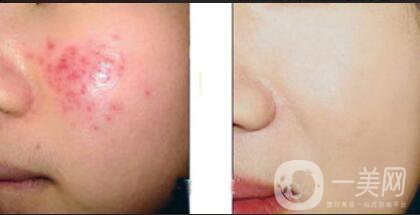 果酸換膚多少錢,果酸換膚注意事項