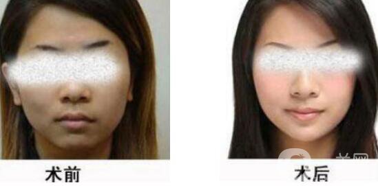 黑臉娃娃縮小毛孔多少錢？