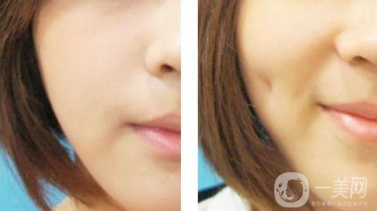 酒窩成形術(shù)的價格 酒窩做什么手術(shù)