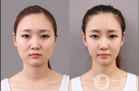 打*一針多少錢 打*注意事項