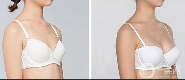 抽脂隆胸整形手術(shù)價格,自體脂肪隆胸注意事項
