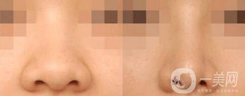 鼻翼縮小價位,鼻翼縮小術(shù)后護(hù)理