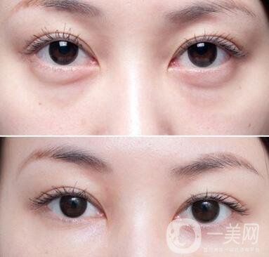 溶脂去眼袋價(jià)格