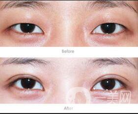 歐式雙眼皮貴嗎,歐式雙眼皮價(jià)格