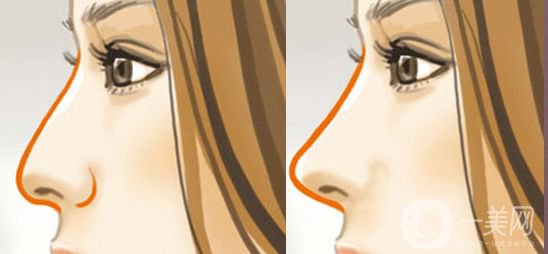 自體隆鼻手術(shù)價格 自體脂肪填充的方法