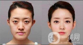 下頜角切除手術(shù)多少錢