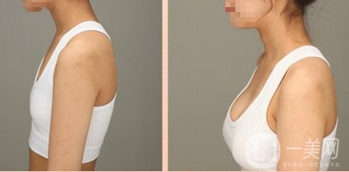 假體豐胸有什么后遺癥嗎 后遺癥嚴重嗎？