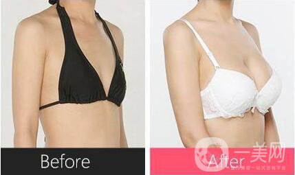 假體隆胸取出整形手術(shù)價格 假體隆胸的手術(shù)方式