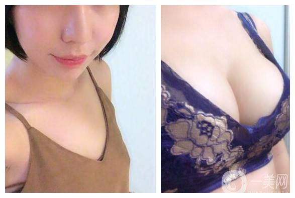 自體抽脂隆胸貴嗎 隆胸材料有哪些