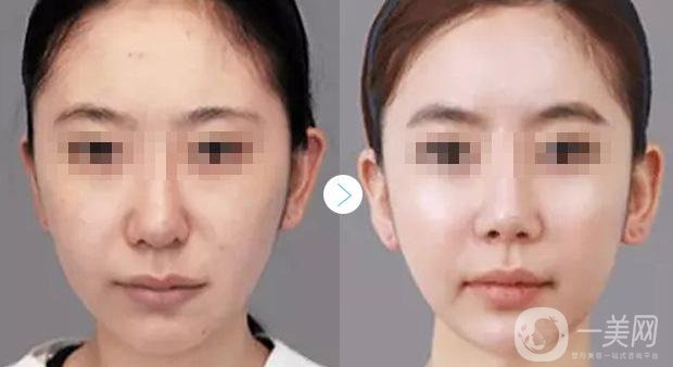 *注射適宜人群有哪些 *果怎么樣？