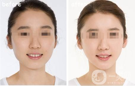 *能維持多長(zhǎng)時(shí)間 注射*注意事項(xiàng)