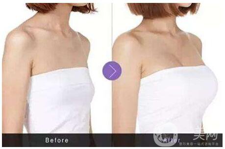 隆胸選擇哪種材料*好？隆胸醫(yī)生教你選擇！