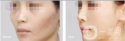 自體脂肪面部填充優(yōu)缺點(diǎn),自體脂肪面部填充