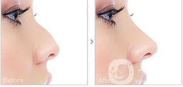 耳軟骨隆鼻整形價(jià)格