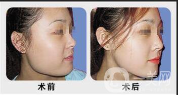 下頜角磨骨整形價(jià)格,下頜角磨骨多少錢