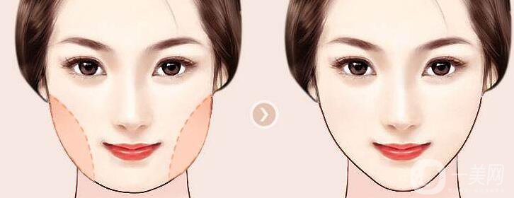 吸脂瘦臉手術(shù)大概多少錢(qián) 吸脂瘦臉有風(fēng)險(xiǎn)嗎