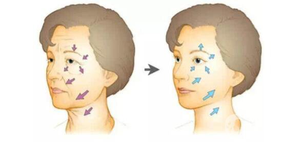 玻尿酸去法令紋的價錢 時間保持久嗎？