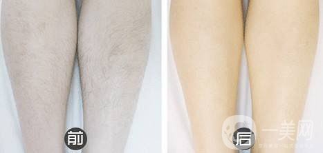 *性脫毛的價(jià)格 脫毛的方法