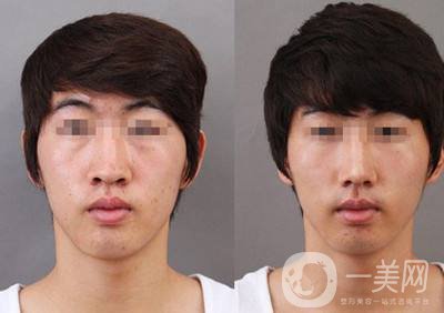 鼻翼縮小手術(shù)價格 鼻翼縮小方法